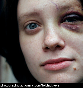 Photo of a black eye