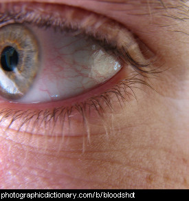 Photo of bloodshot eyes.